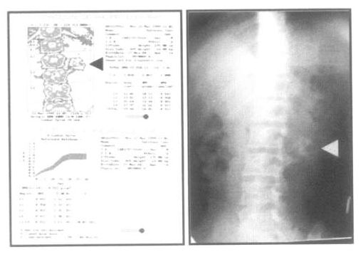 Очаг кальцификации на уровне LII–LIII (остеохондрома): слева – денситометрия; справа – рентгенография позвоночника в косой проекции