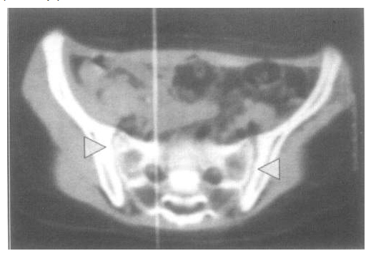 Компьютерно-томографическое изображение ранней стадии сакроилеита: эрозии смежных суставных поверхностей (указано стрелкой) у больного ЮАС
