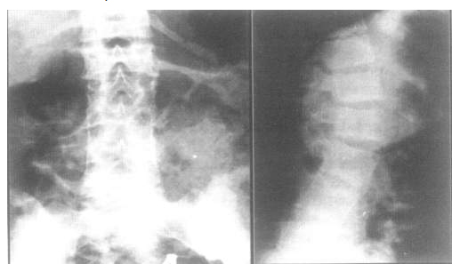 Рентгенологическая картина переднего спондилита и обызвествления передней продольной связки поясничного отдела позвоночника у больного ЮАС